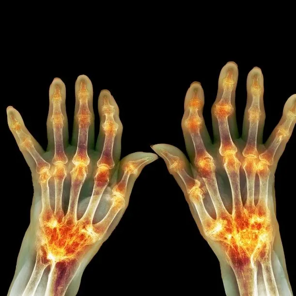 A photo of a patient with arthritis pain.